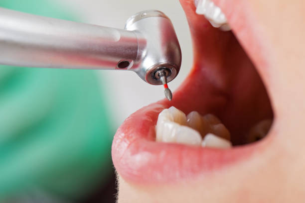Best Urgent Care for Lost Fillings or Crowns in Pimmit Hills, VA